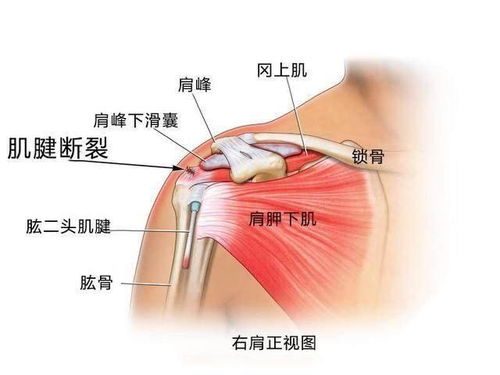 高尔夫球肌肿