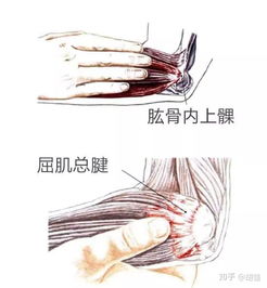 高尔夫球肘疼痛缓解方法